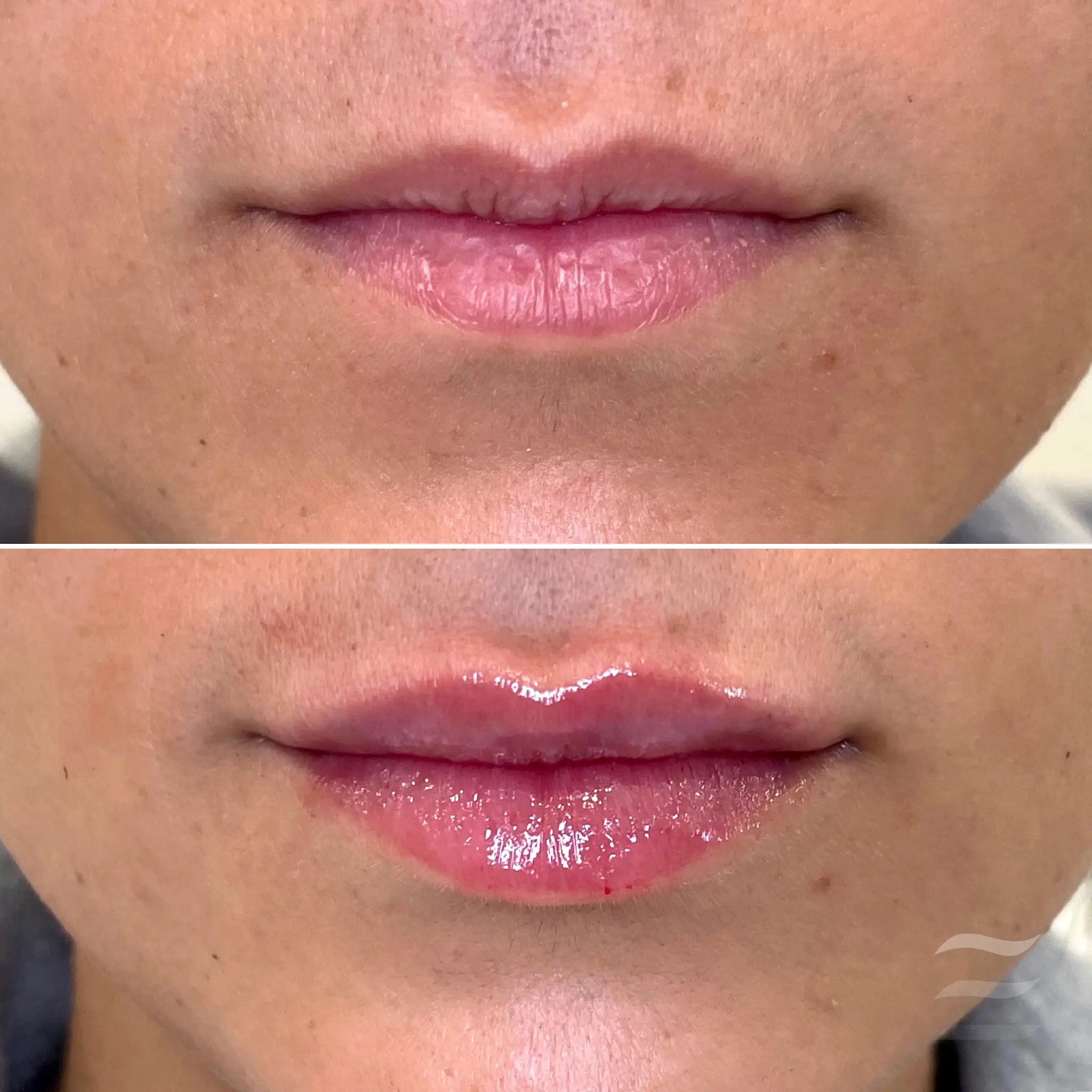 Lip Filler