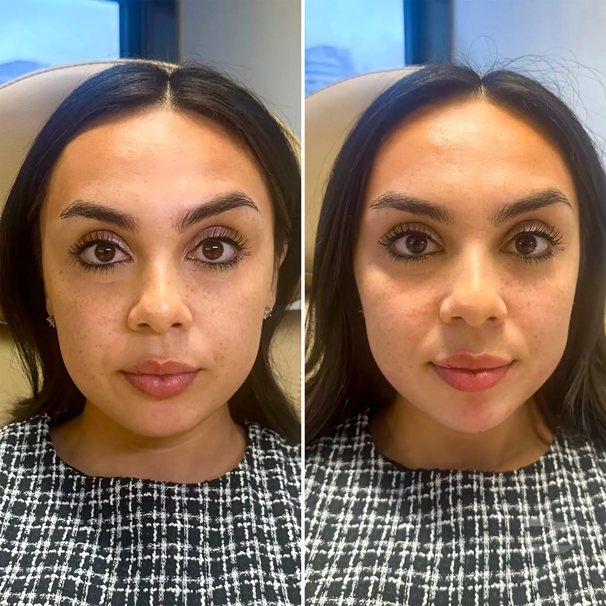 Cheek and Chin Filler