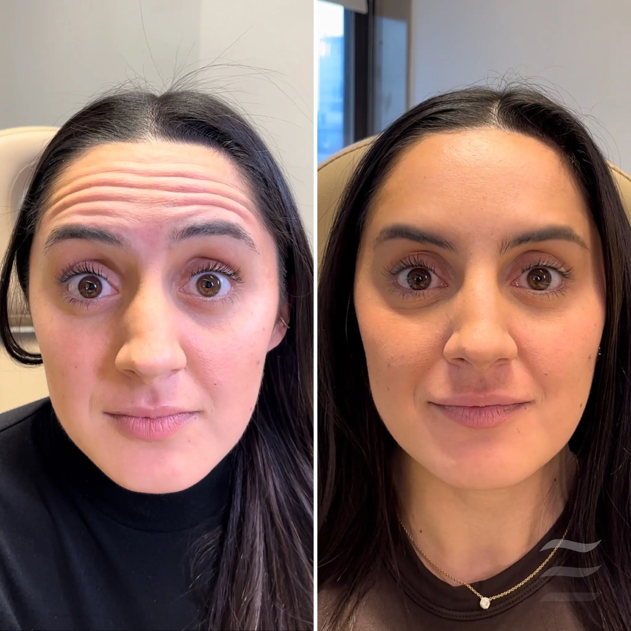 Forehead Lines Botox