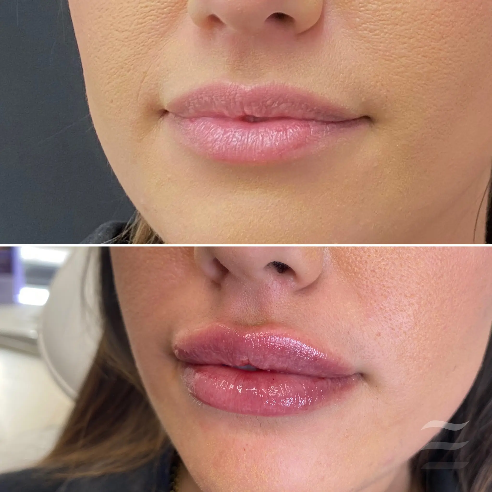 Lip Filler