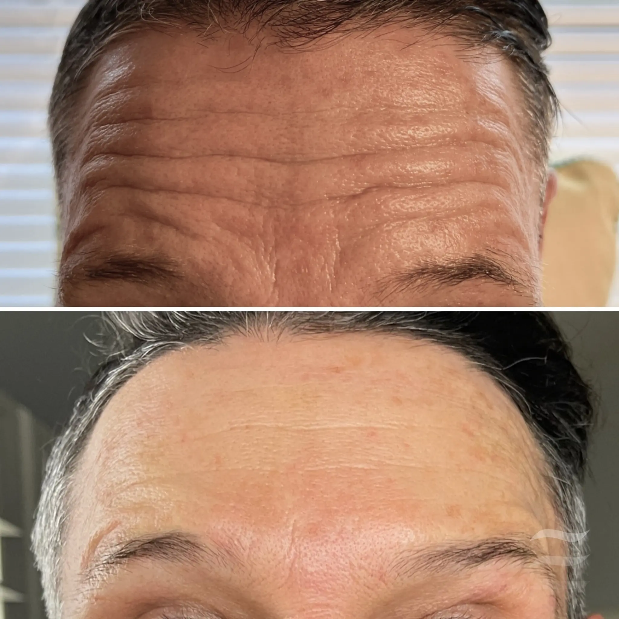 Forehead Lines Botox
