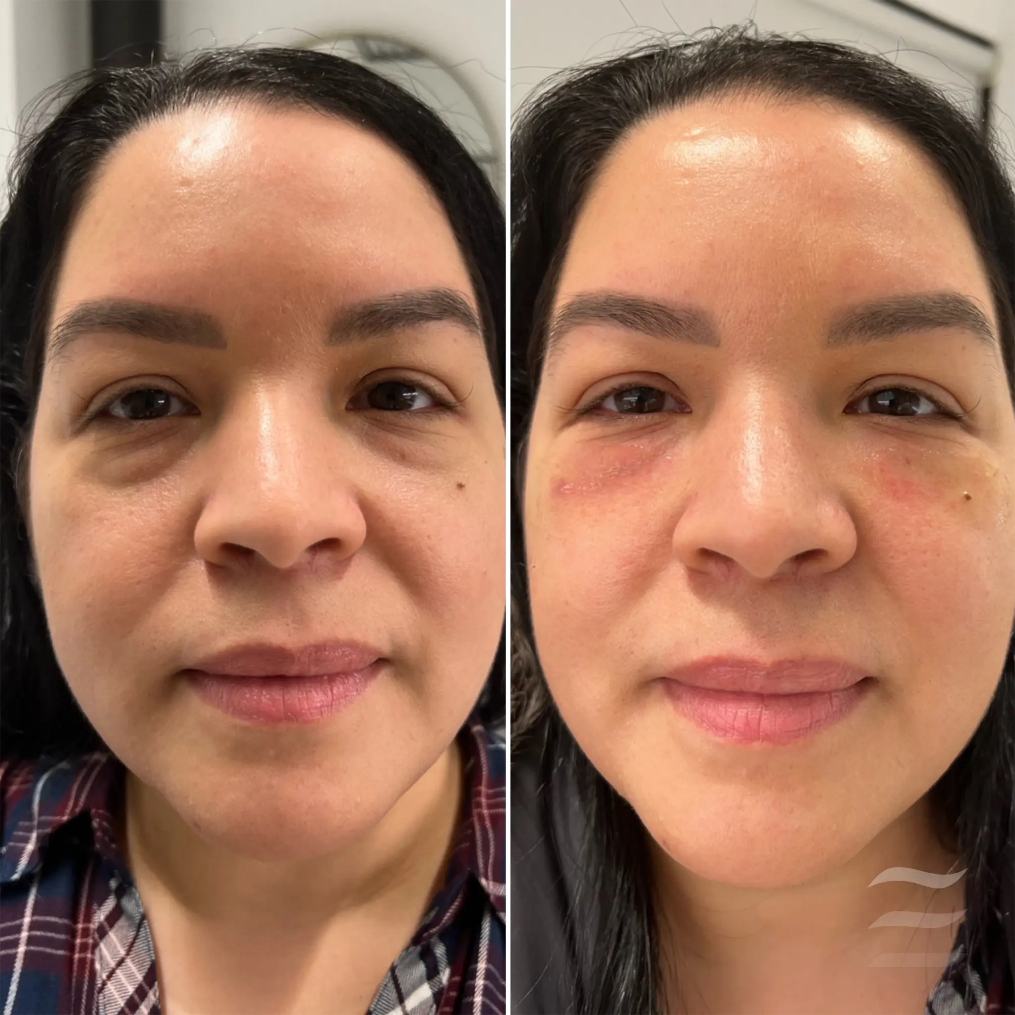 PRP Undereye Injections