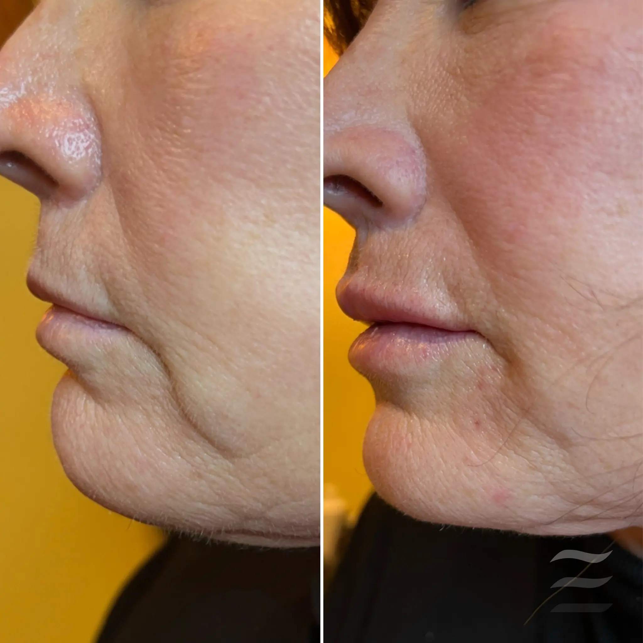 Lip Flip Botox and Marionette Lines Filler