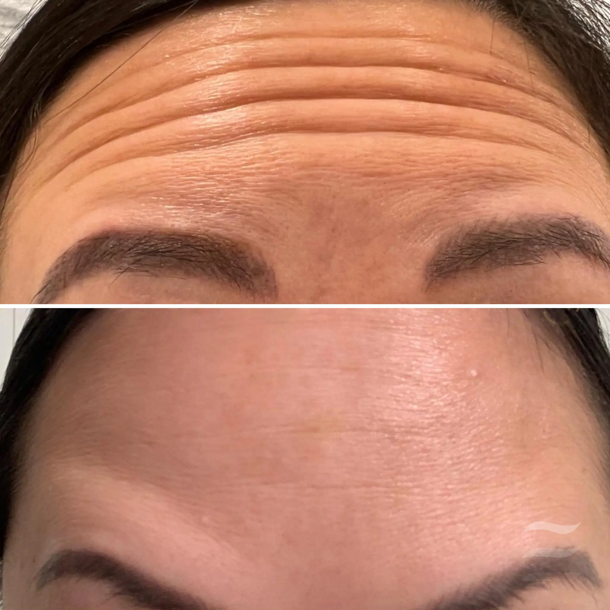 Forehead Lines Botox