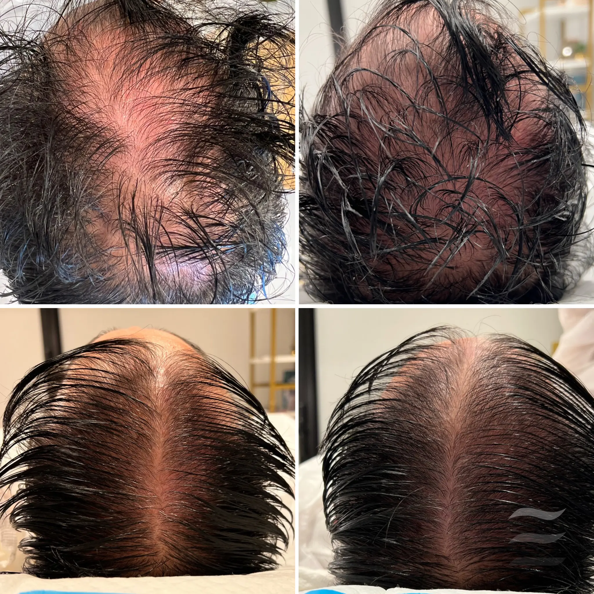 PRP Hair Restoration