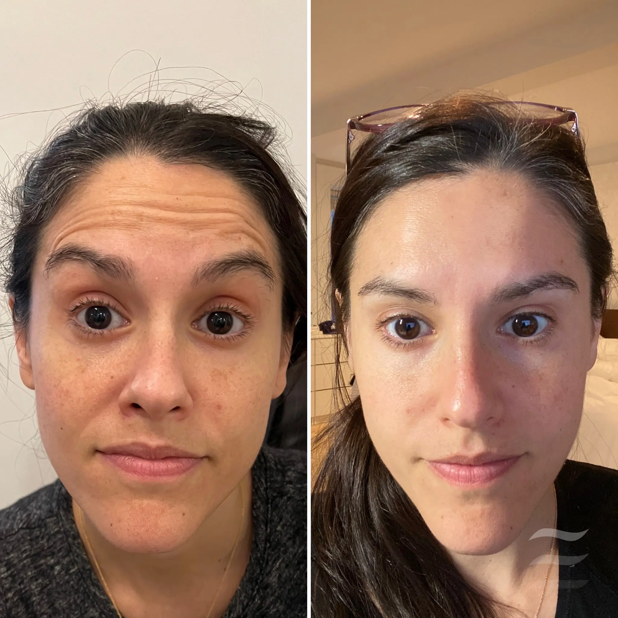 Forehead Lines Botox