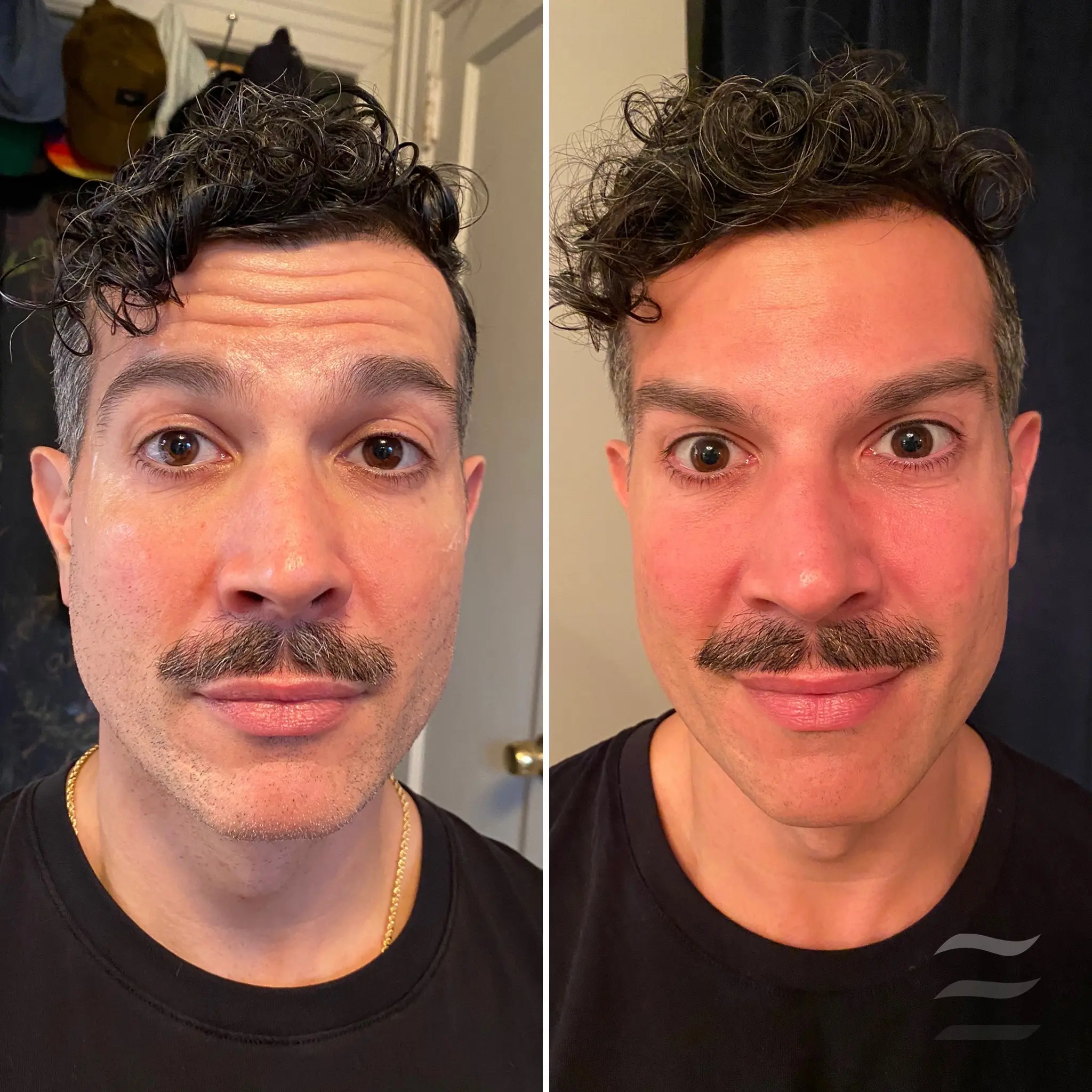 Forehead Lines Botox