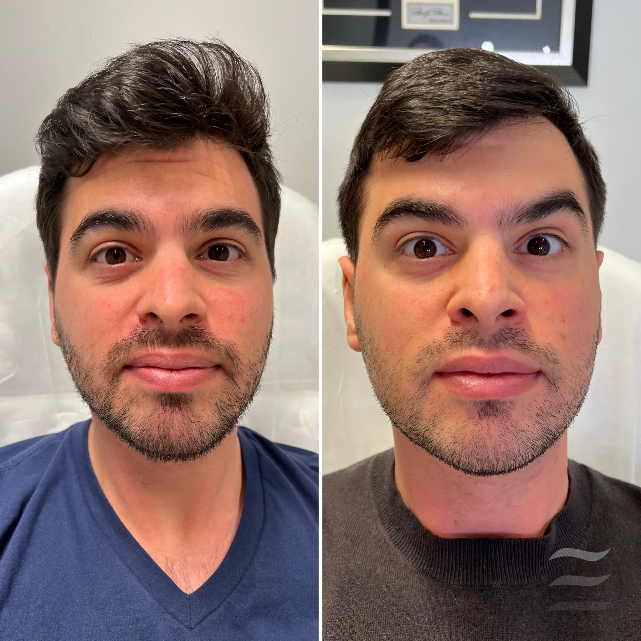 Forehead Lines Botox