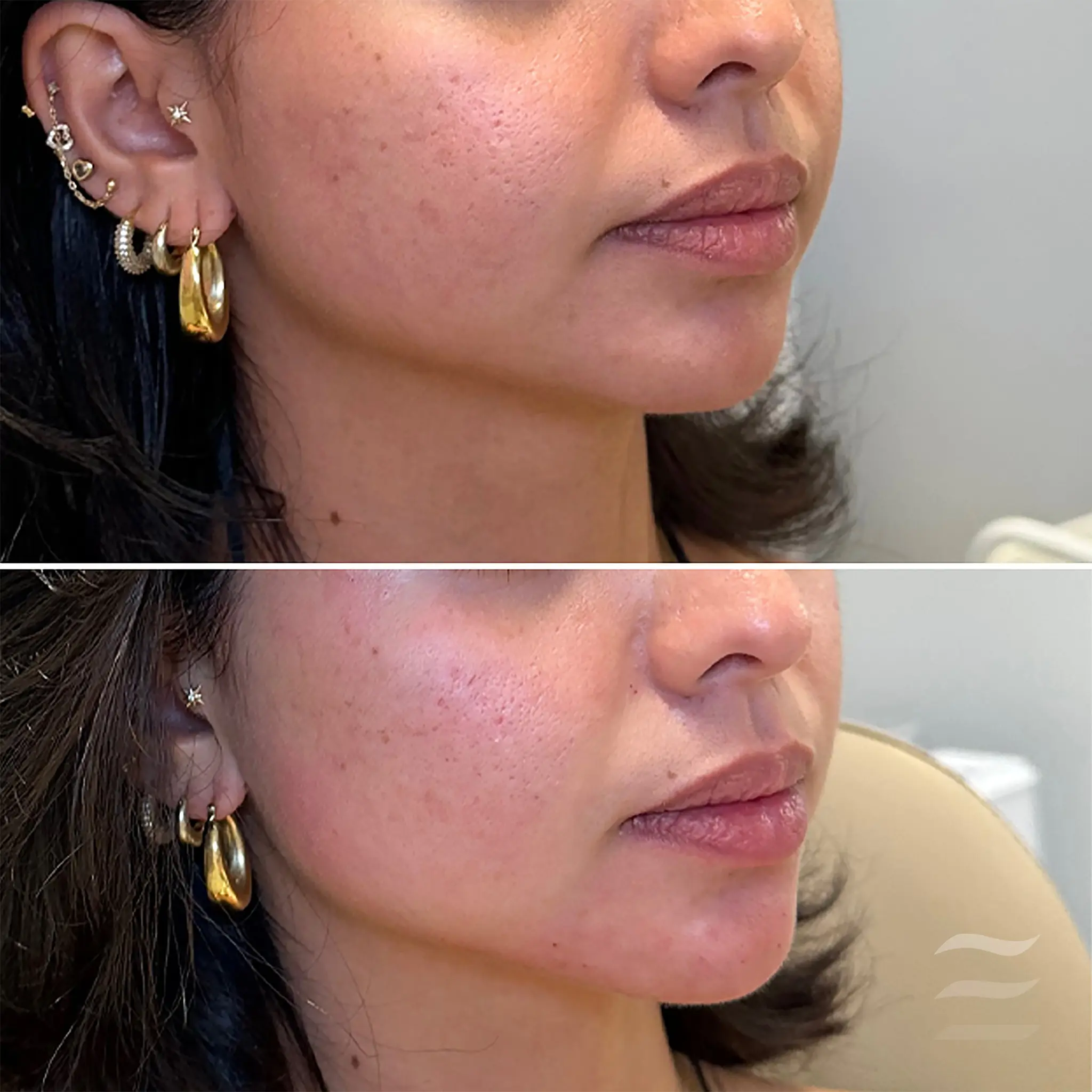 Cheek and Chin Filler