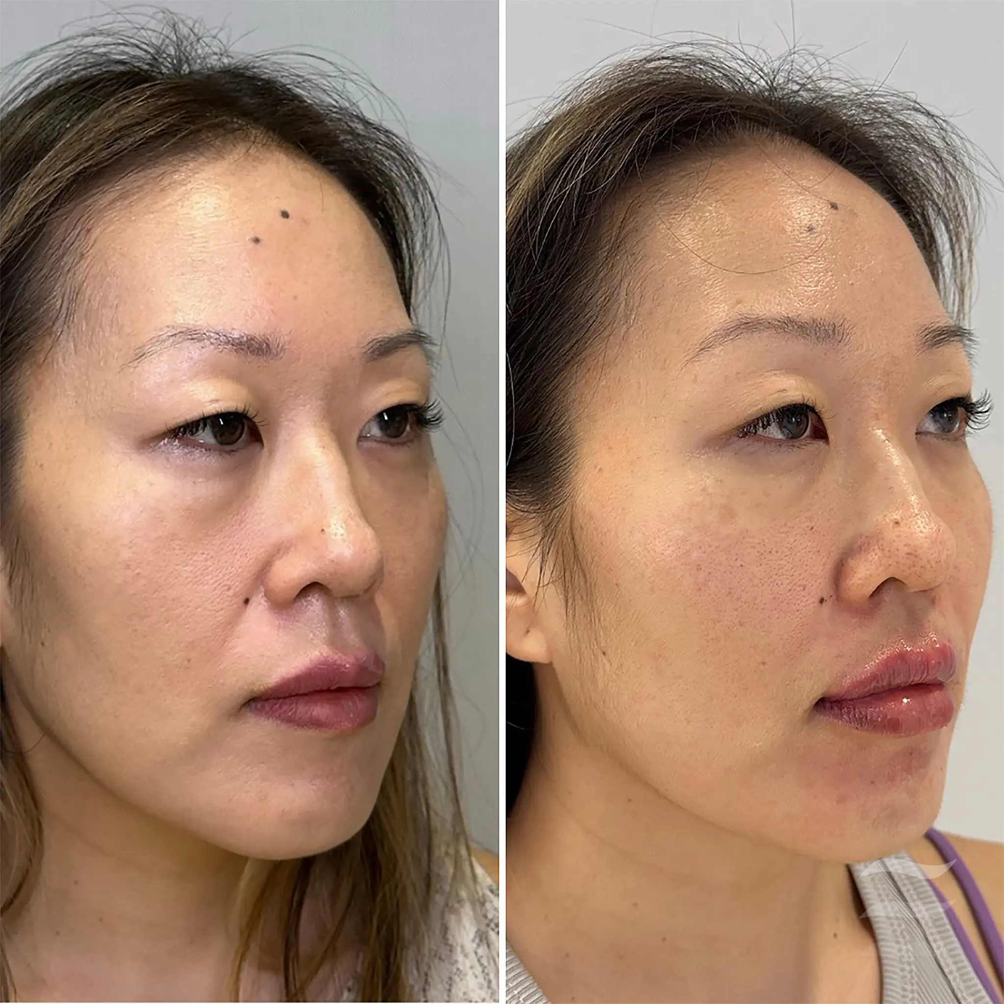 Midface Rejuvenation