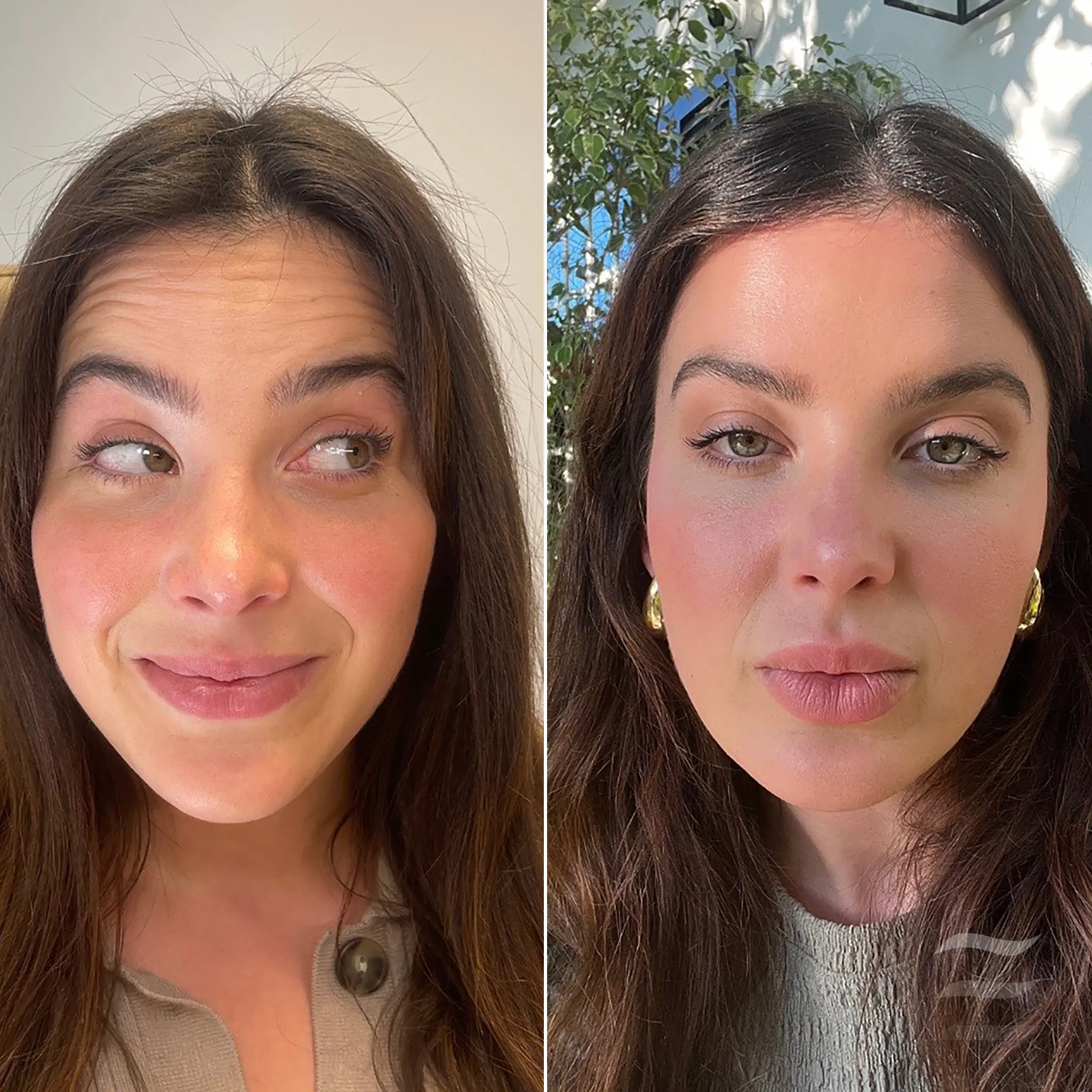 Forehead Lines Botox