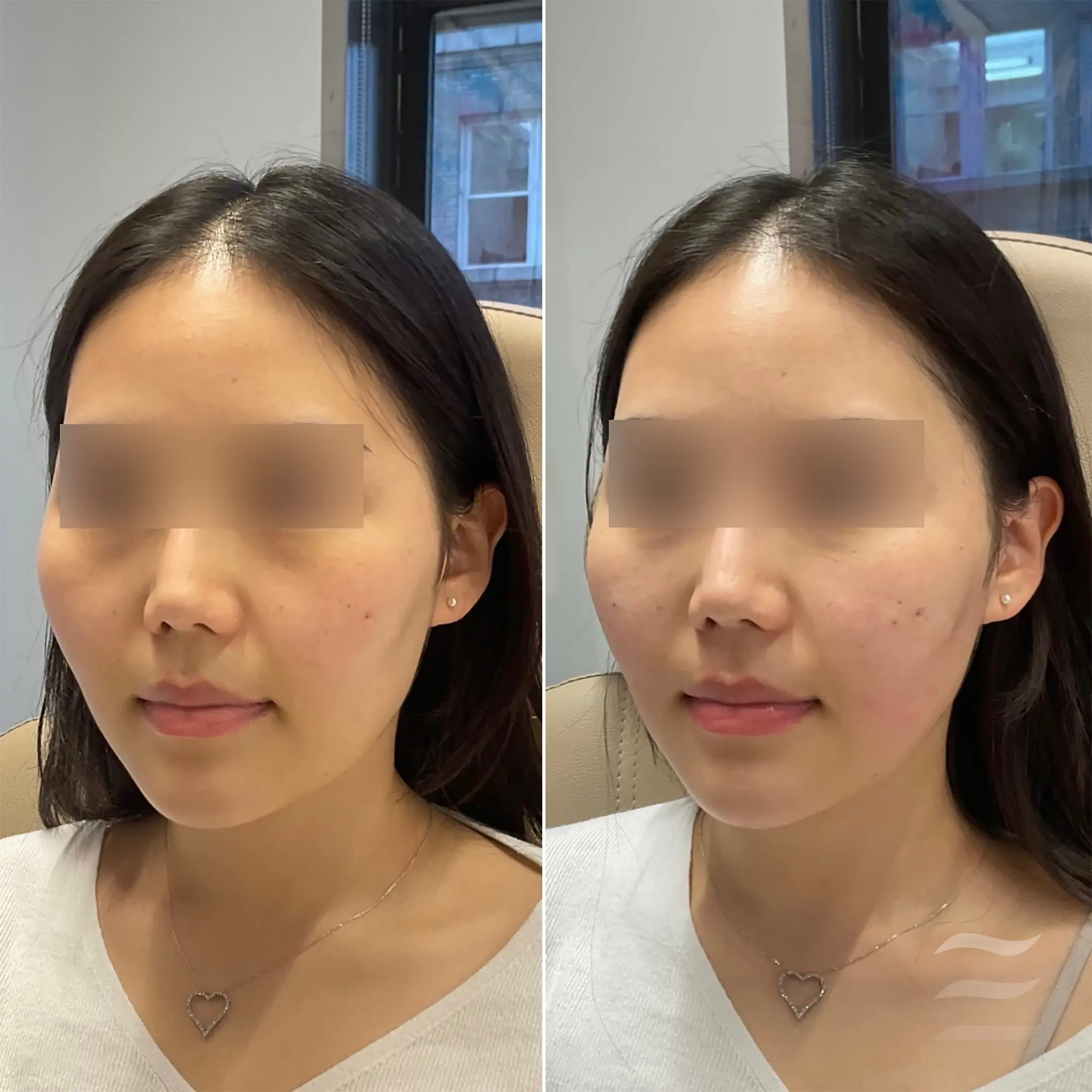Cheek and Temple Filler