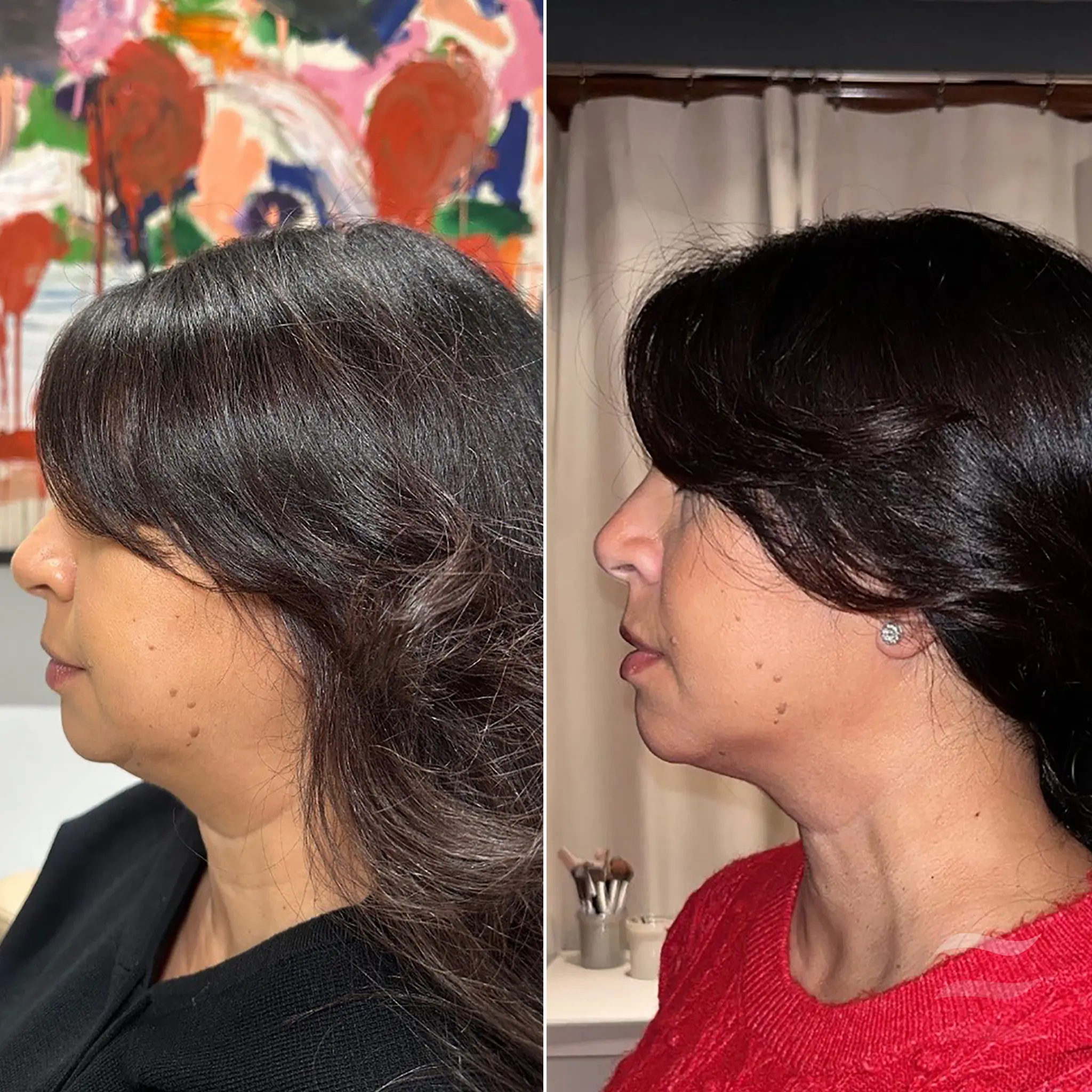 Neck Lift Botox