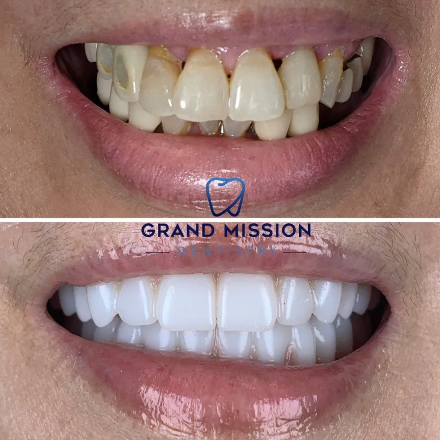 Before and after smile transformation at Grand Mission Dentistry