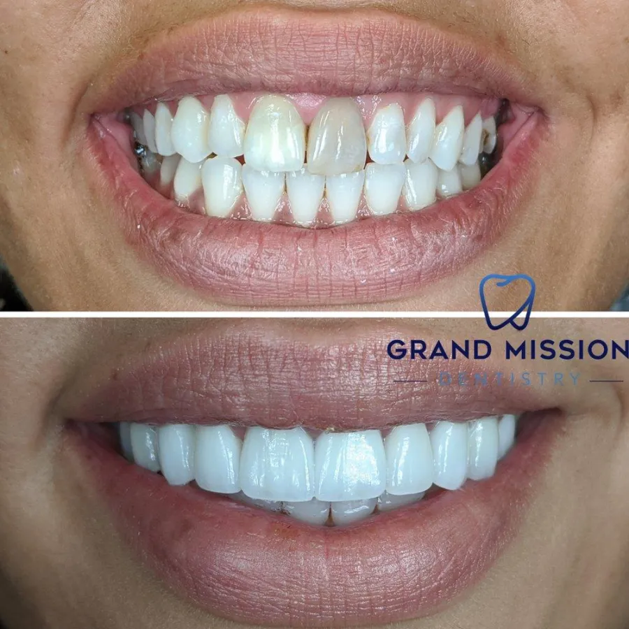 Before and after cosmetic dentistry at Grand Mission Dentistry