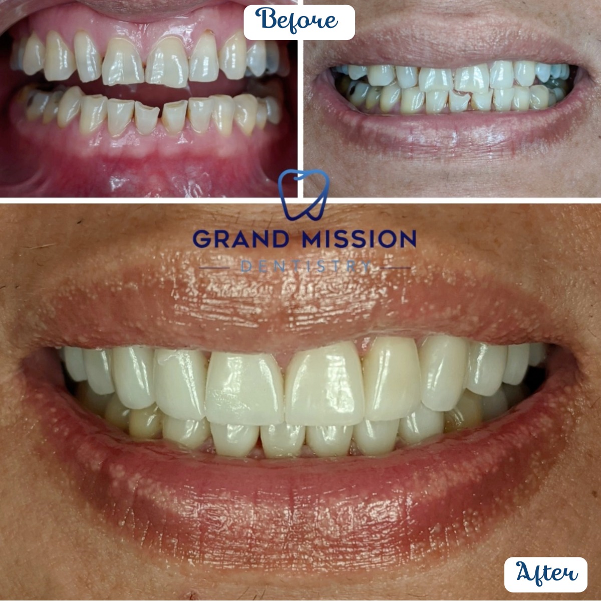 Before and after veneer case at Grand Mission Dentistry