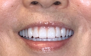After treatment at Grand Mission Dentistry