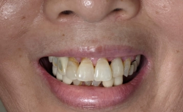 Before treatment at Grand Mission Dentistry
