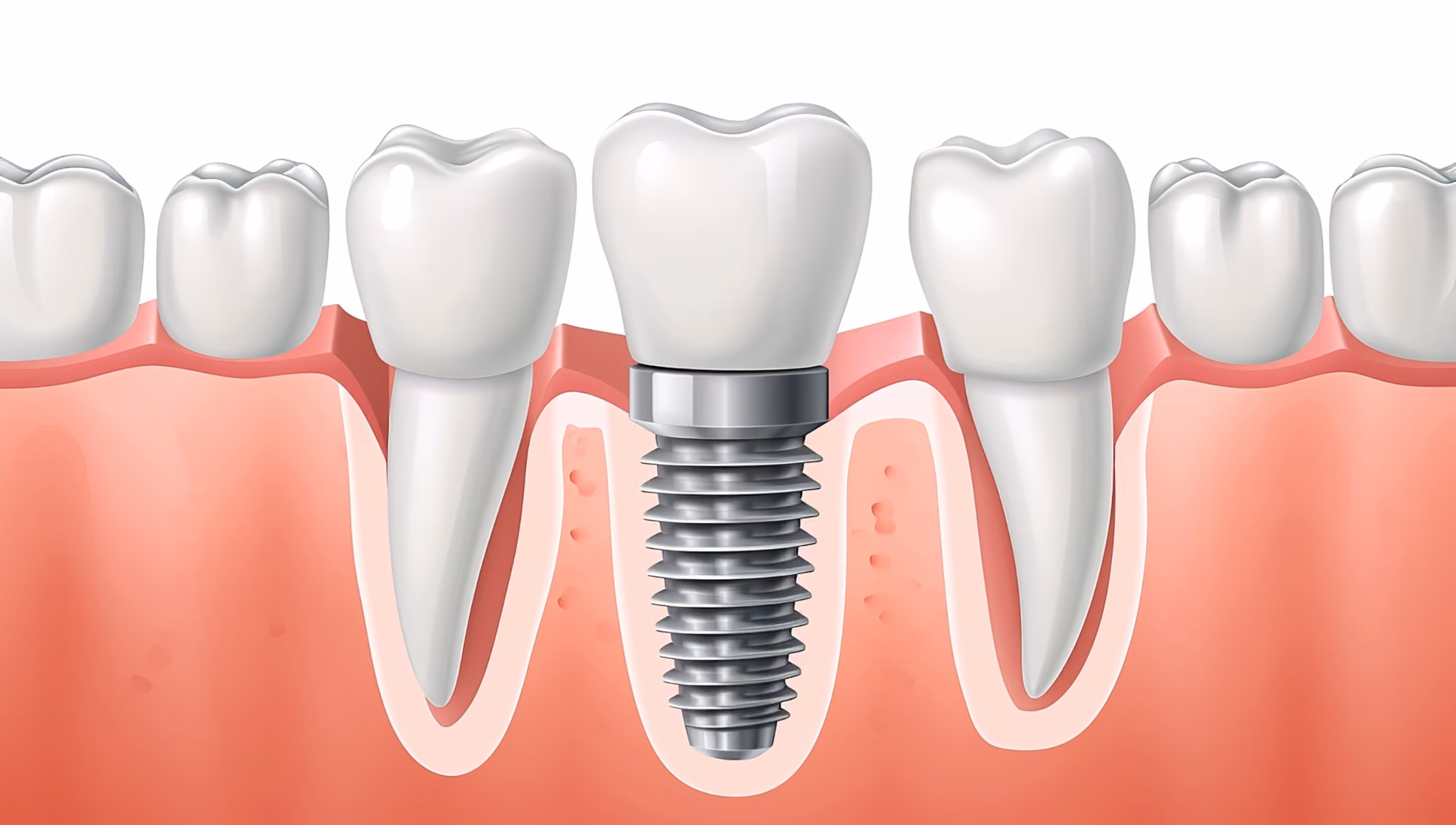 Illustration about maximizing dental insurance benefits for implant treatment