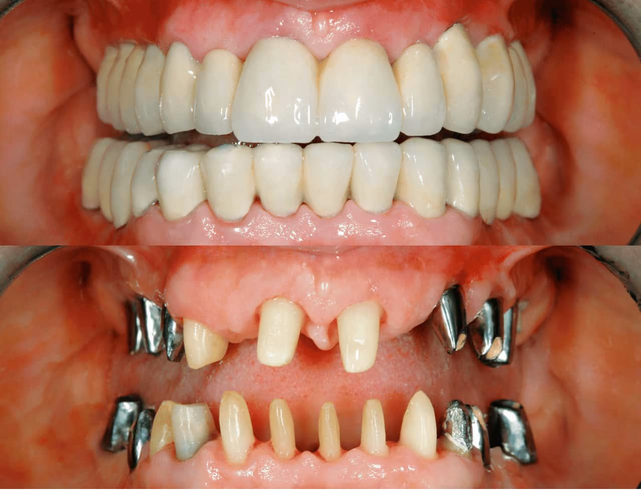 Common Myths About Full Mouth Reconstruction