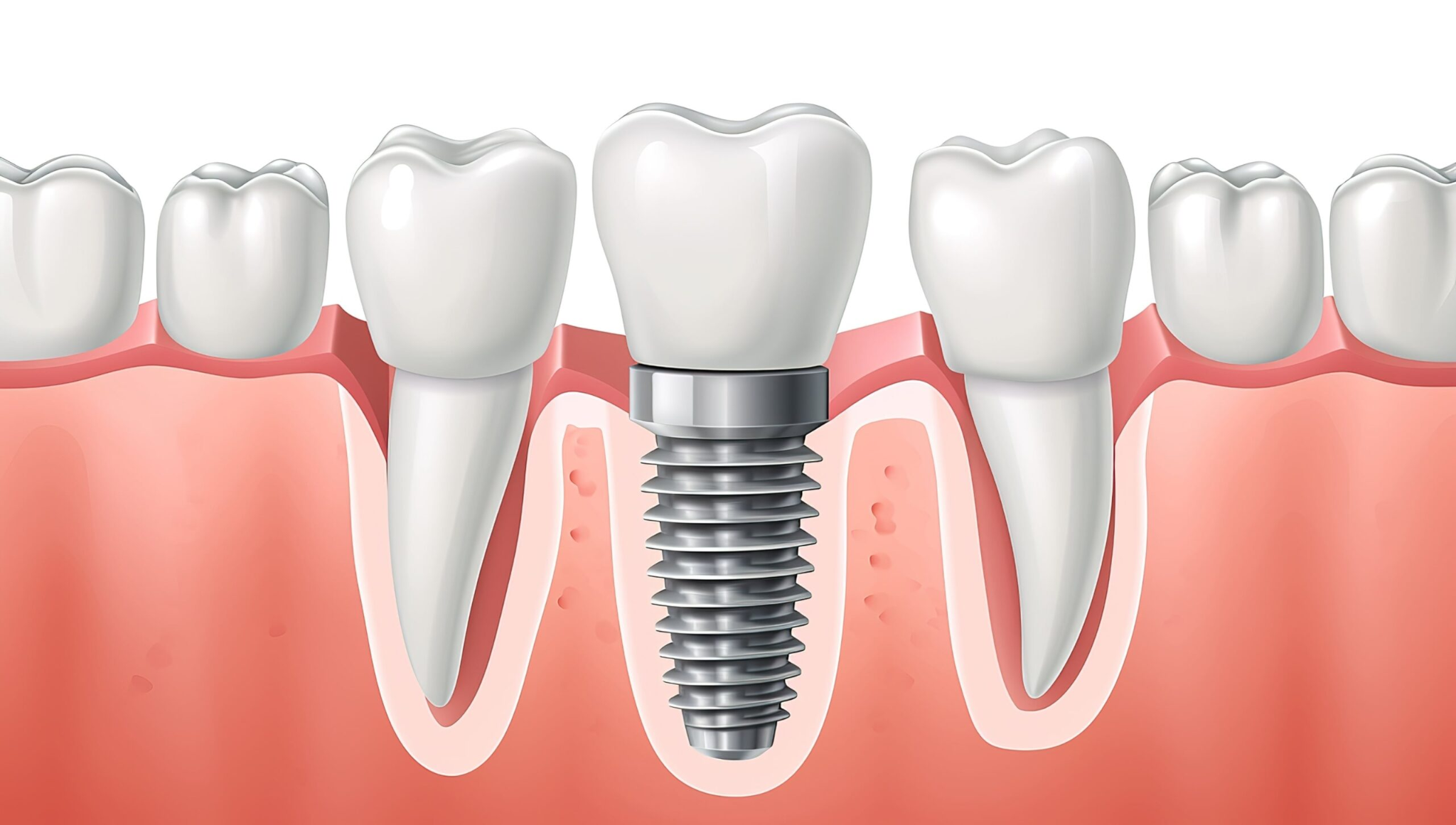 It is necessary to maximize insurance benefits to reduce the cost of dental implants