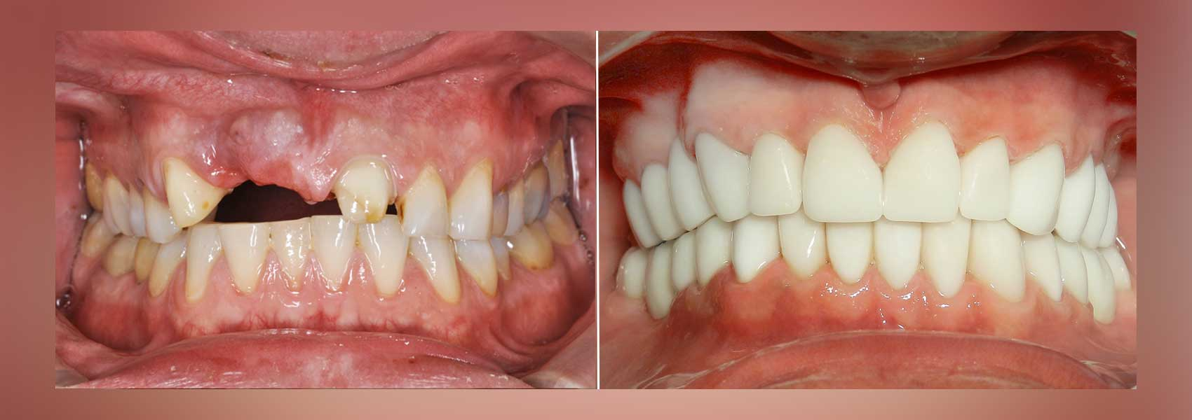 Candidate for Full Mouth Reconstruction