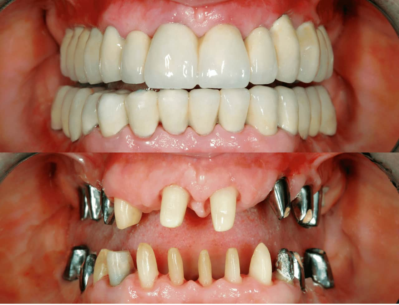 Common Myths About Full Mouth Reconstruction