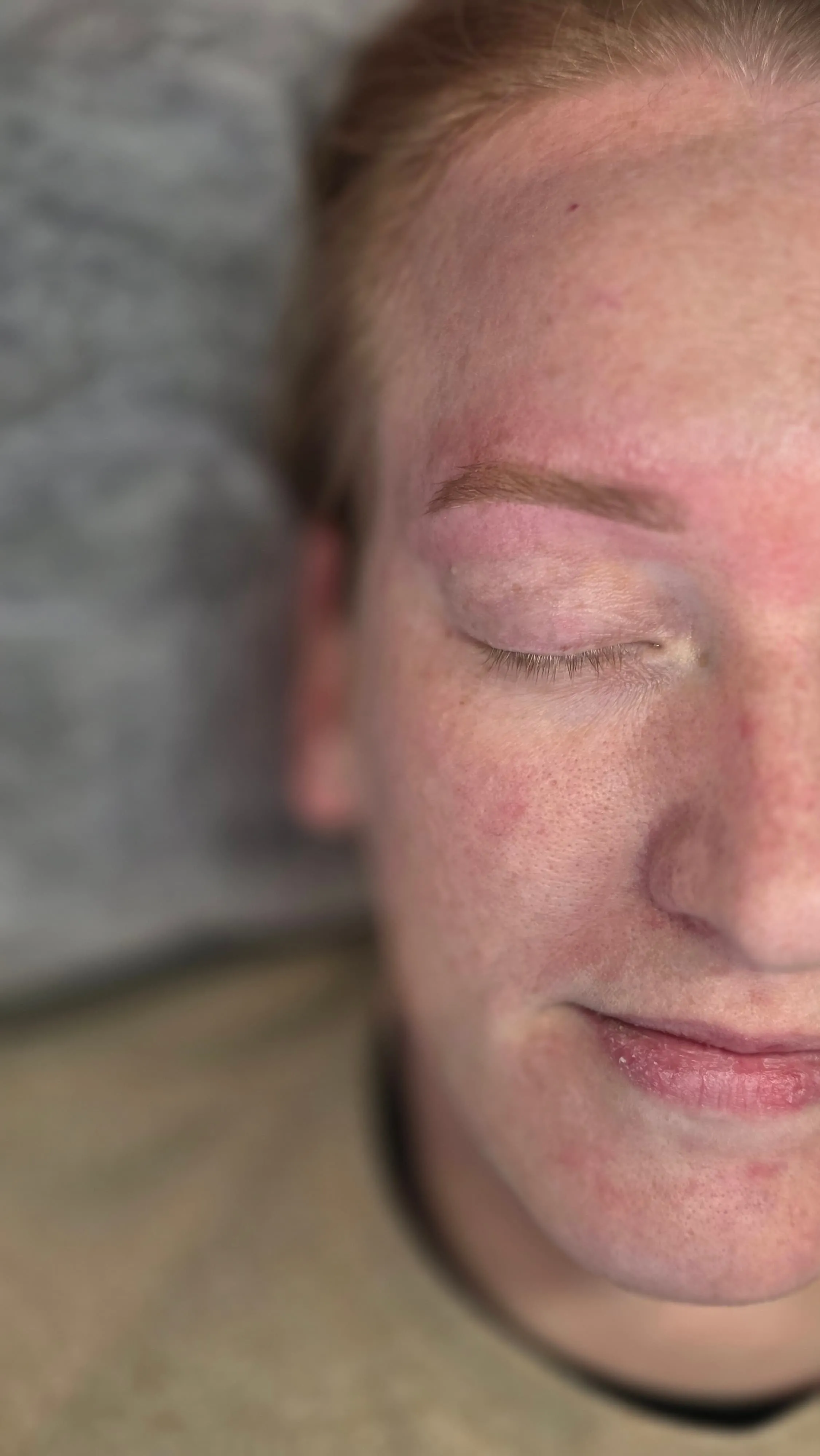 Close-up of a person's face with eyes closed, showing light freckles, redness, and textured skin.