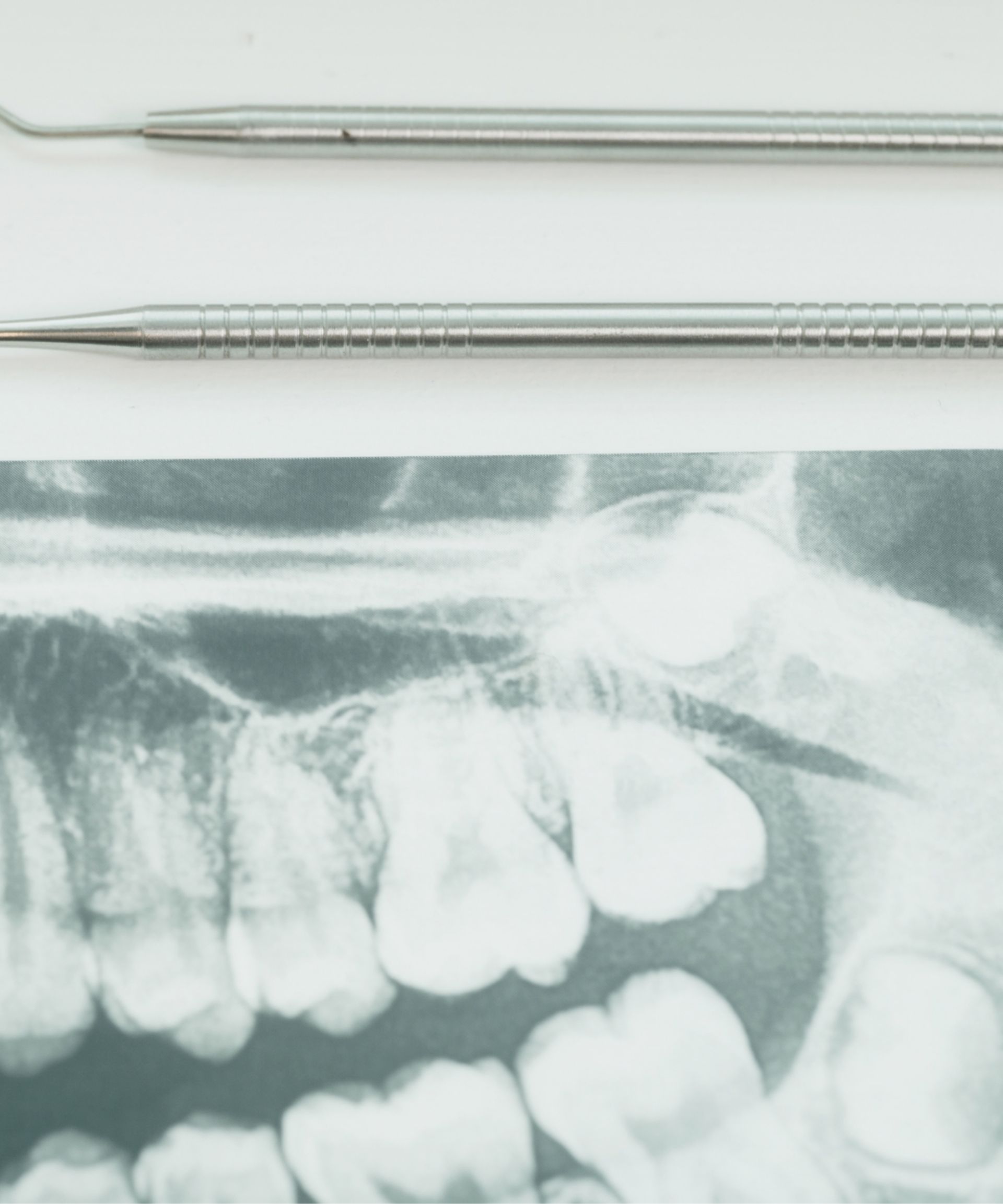 Dental X-ray showing teeth and jawbone with two metal dental tools above it on a white surface.