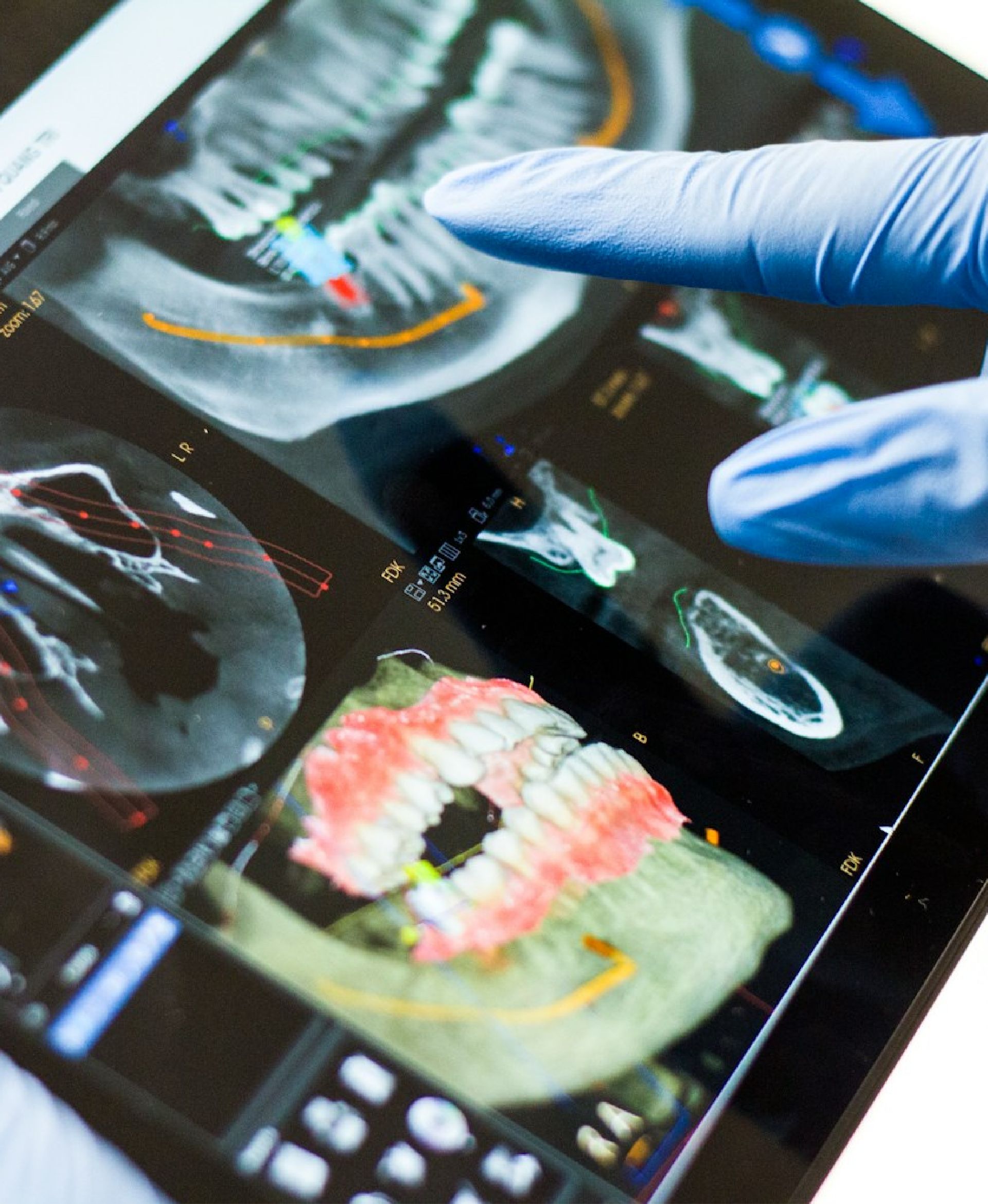 Gloved hand pointing to dental X-rays and 3D images of teeth on a digital screen.