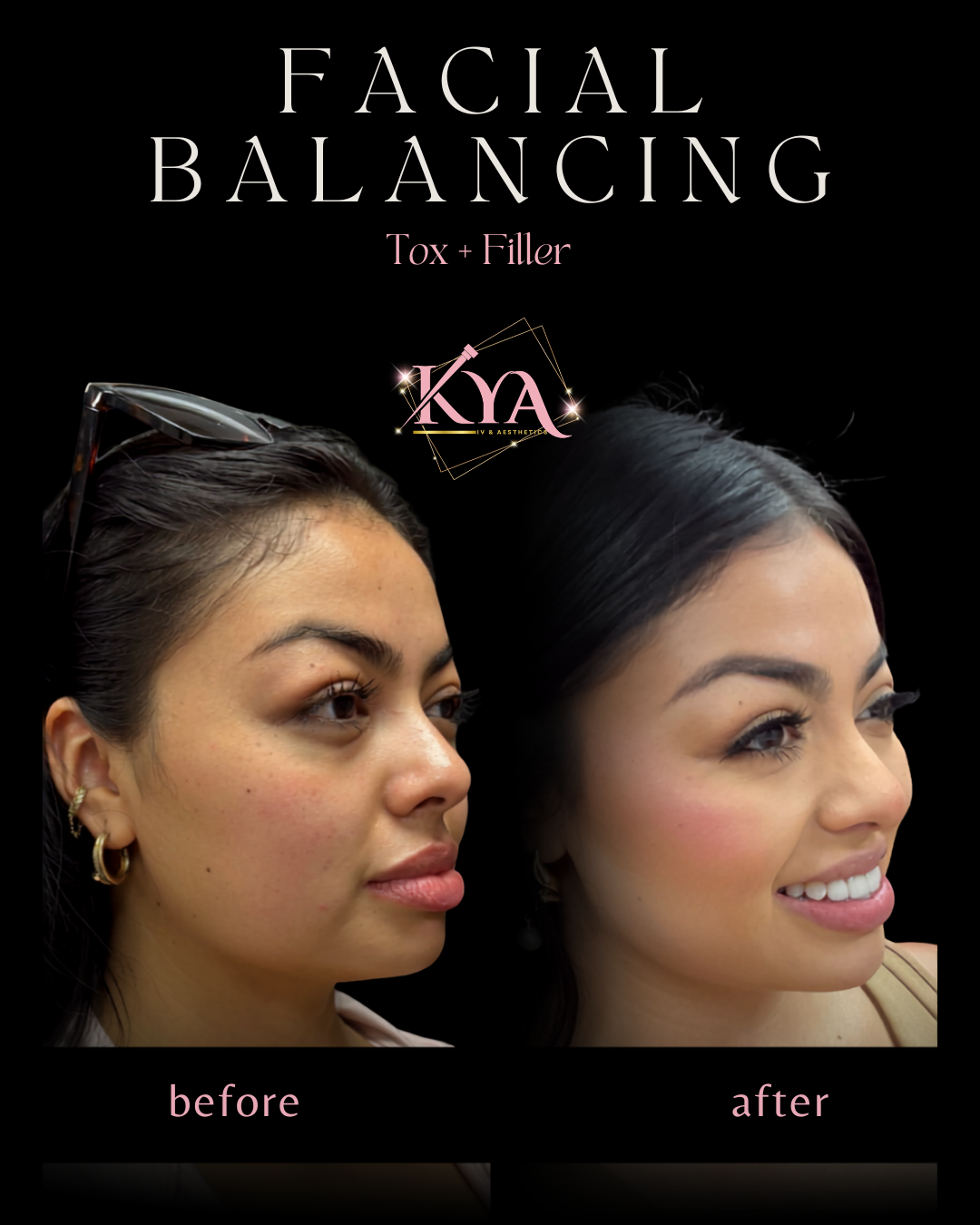 Before and after close-up of lips showing results of lip filler using one syringe.