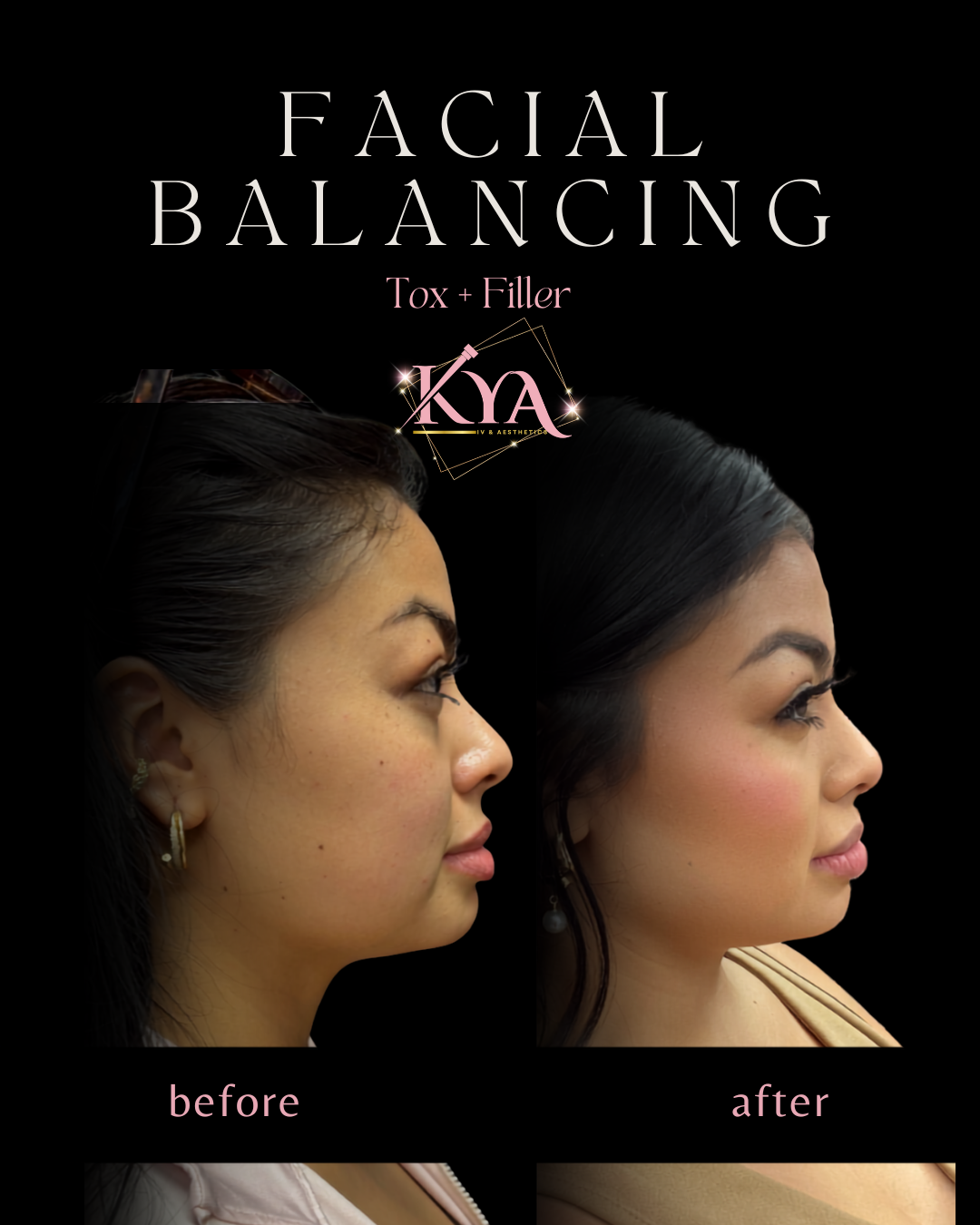 Side-by-side before and after photos showing facial balancing results with tox and filler treatment.