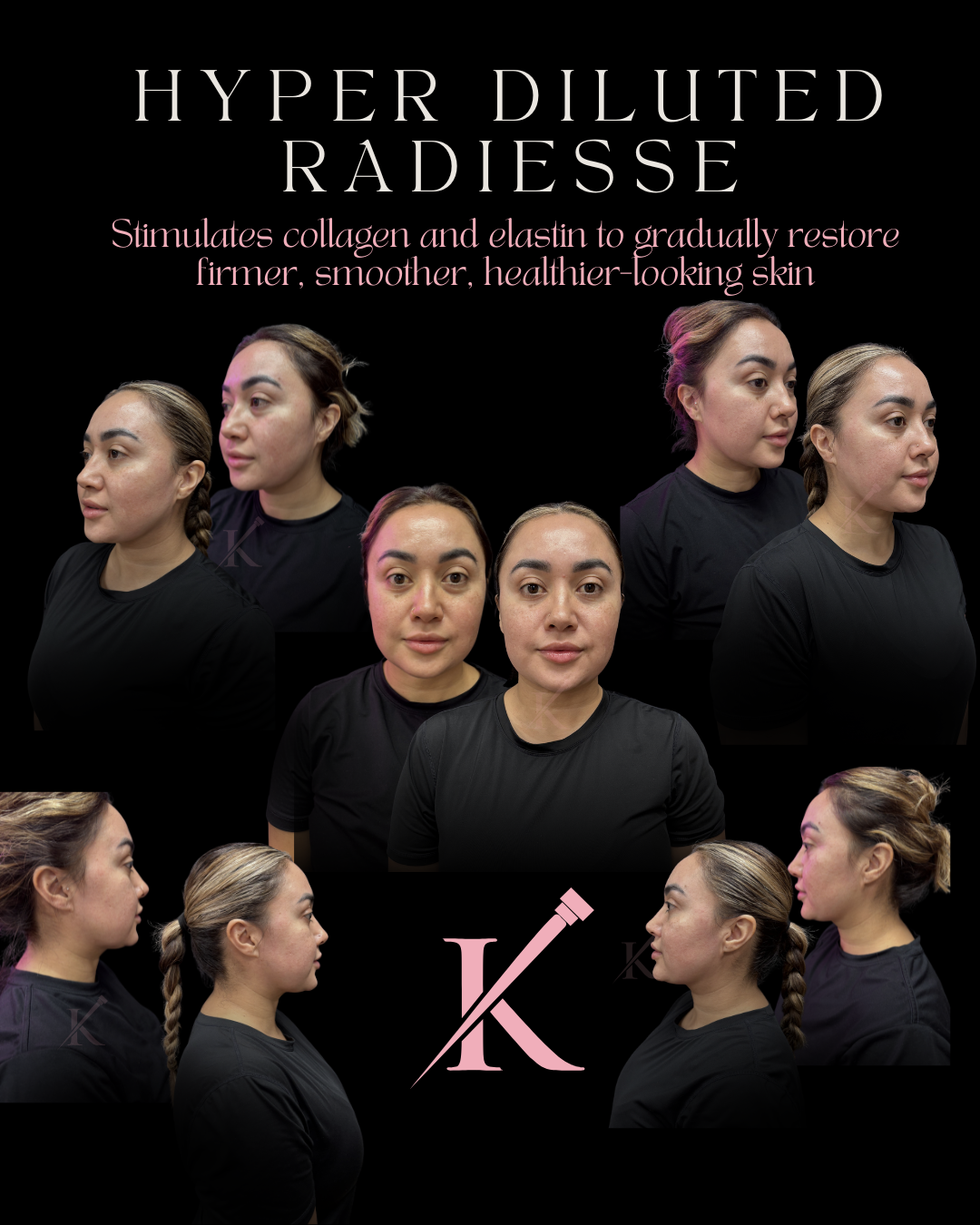 Collage of a woman’s face from multiple angles promoting Hyper Diluted Radiesse for skin firmness and smoothness.