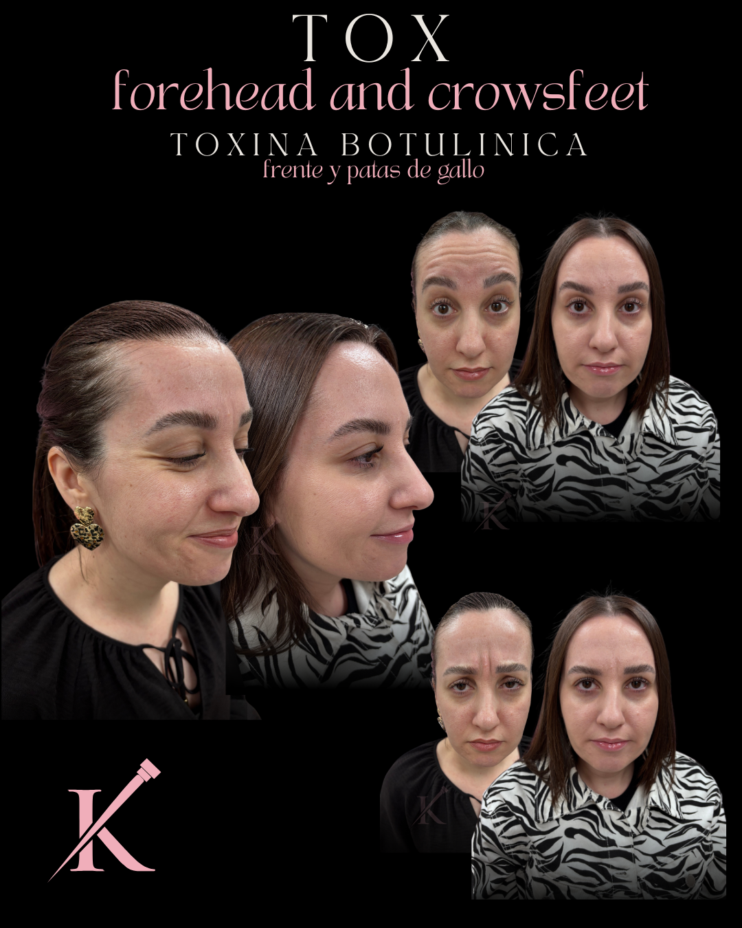 Before and after photos showing forehead and crow's feet treatment with botulinum toxin on a woman.