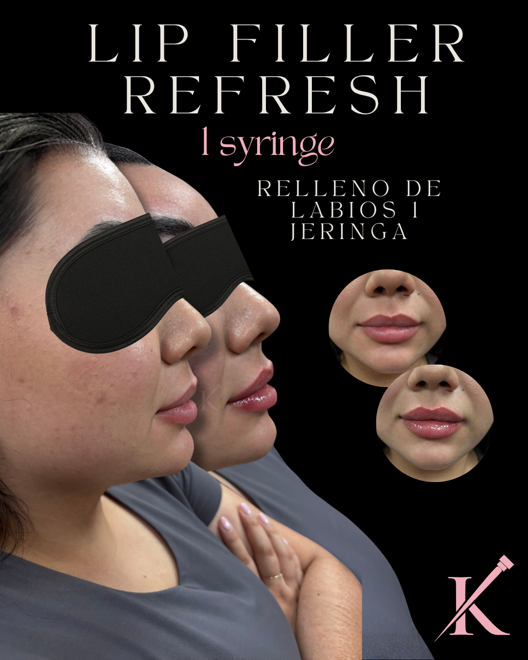 Before and after side and front views of a woman's lips after one syringe lip filler refresh treatment.