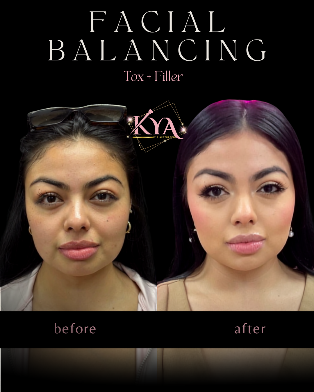 Side-by-side facial before and after photos showing effects of tox and filler for facial balancing.