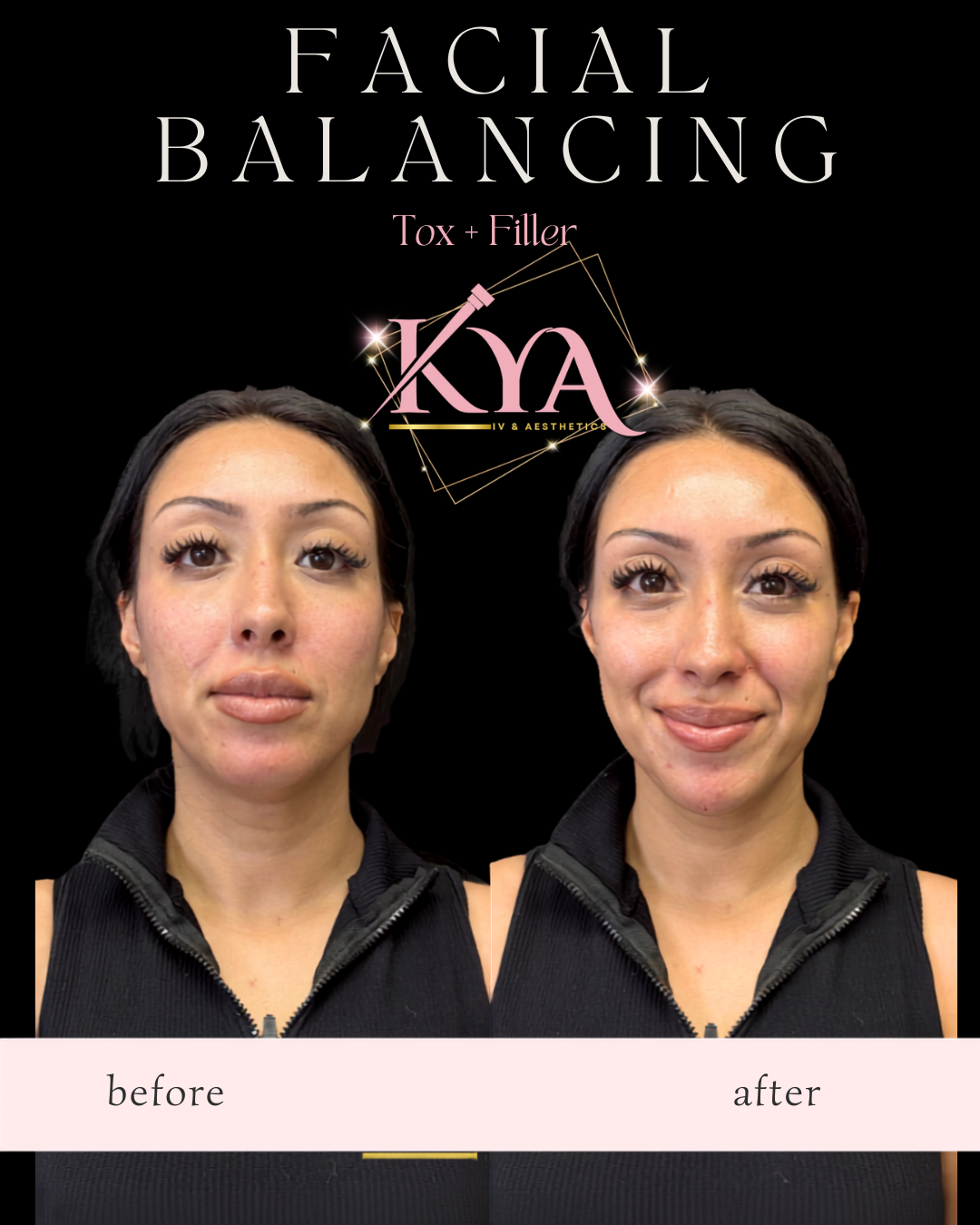 Side-by-side before and after photos of a woman showing facial balancing results with Tox and filler.