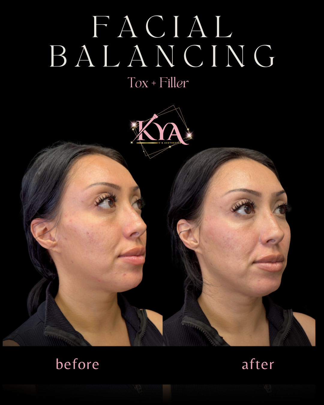 Before and after images showing reduced forehead wrinkles and crow’s feet after botulinum toxin treatment.
