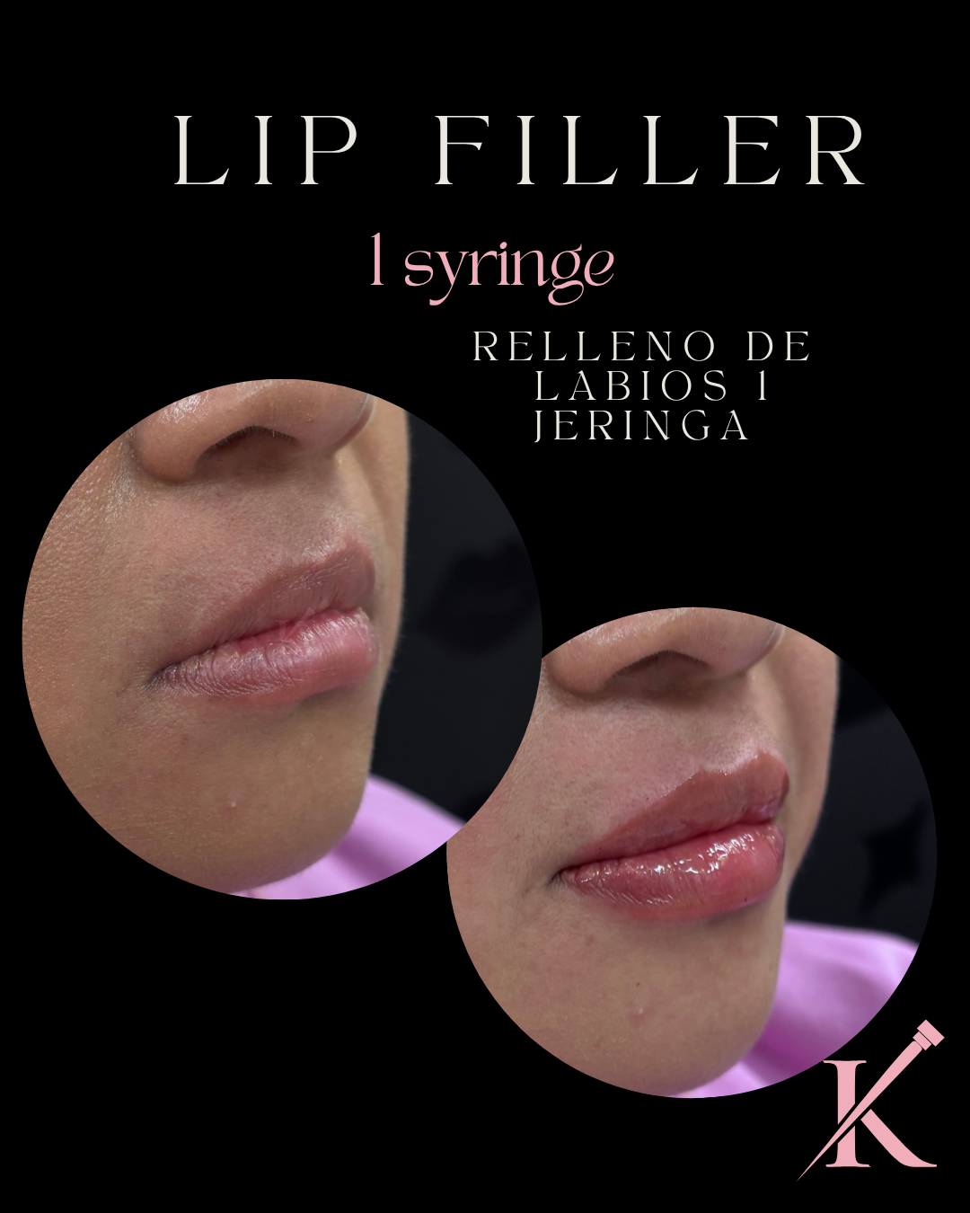 Before and after photos of a lip filler treatment with 1 syringe enhancing lip volume.