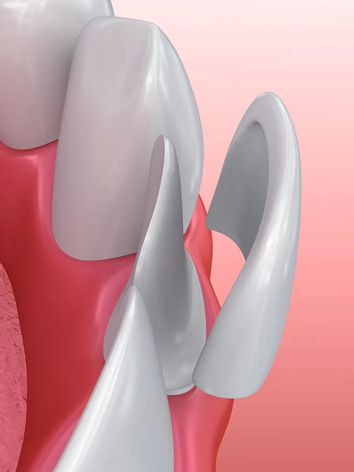 Veneers - Differentiator 4