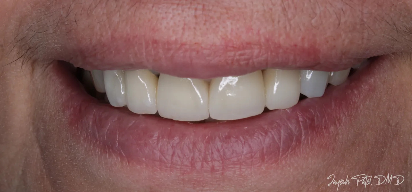 After Image