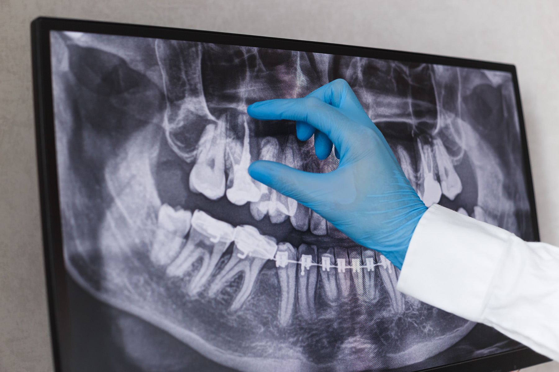 Dental X-ray on a screen showing teeth with braces and a gloved hand pointing at upper teeth.