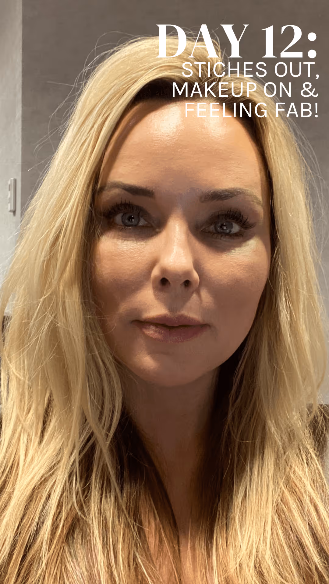 Patient Diary – What's it like to have an upper eyelids blepharoplasty? Day 12