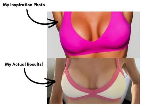 Confident woman one year after cosmetic surgery enjoying natural-looking results in Greenwood, Colorado