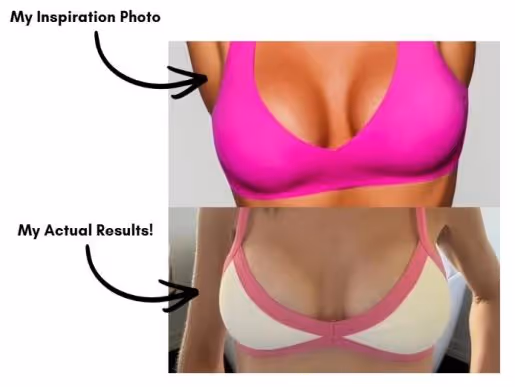 One-year breast lift recovery results showing natural shape and healed surgical outcome