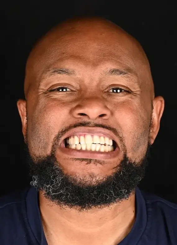 Close-up of a bald man with a thick beard grimacing and showing clenched teeth against a black background.
