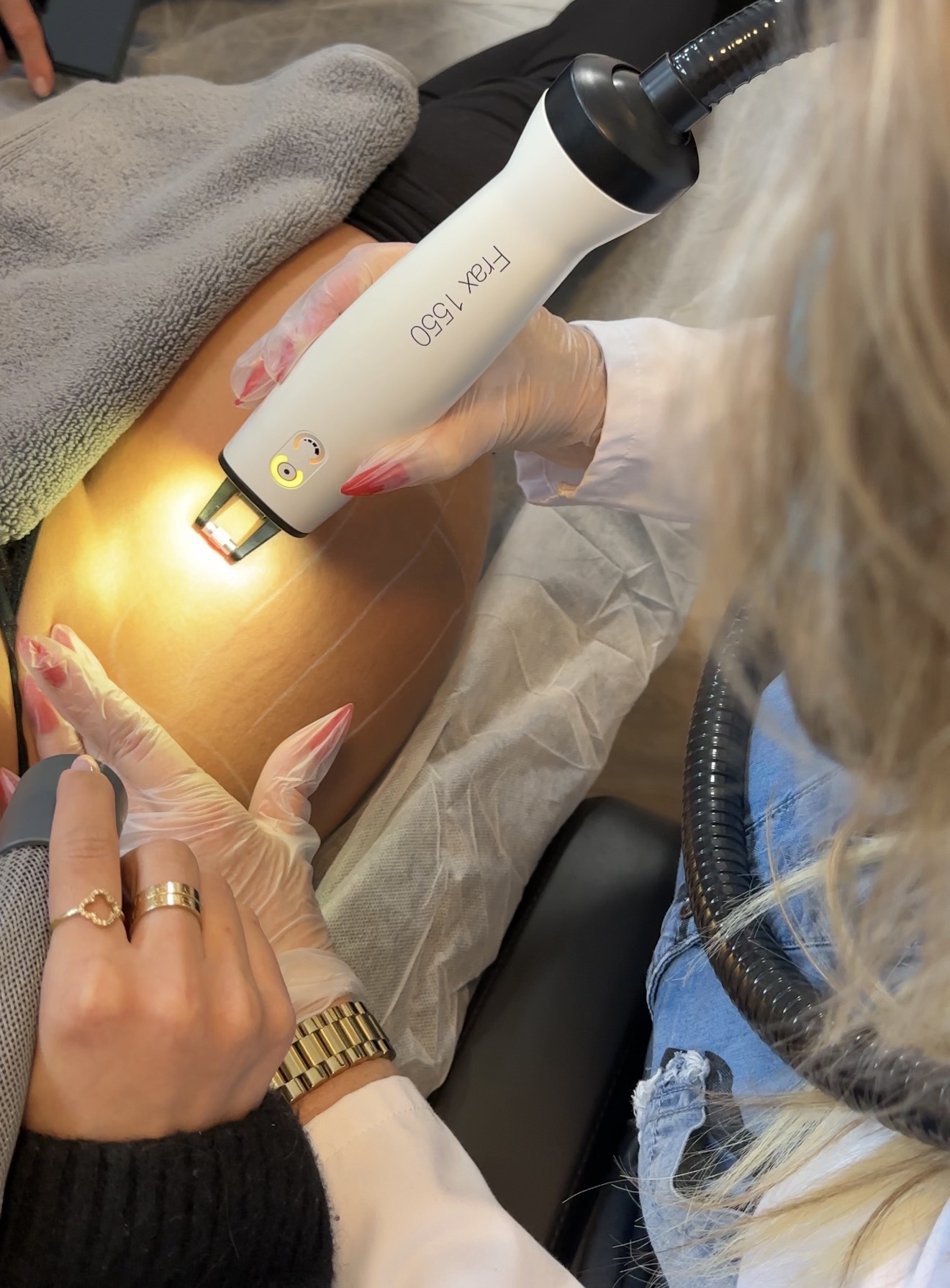 Laser Dehnungsstreifen Behandlung Bonn – Haute Contour