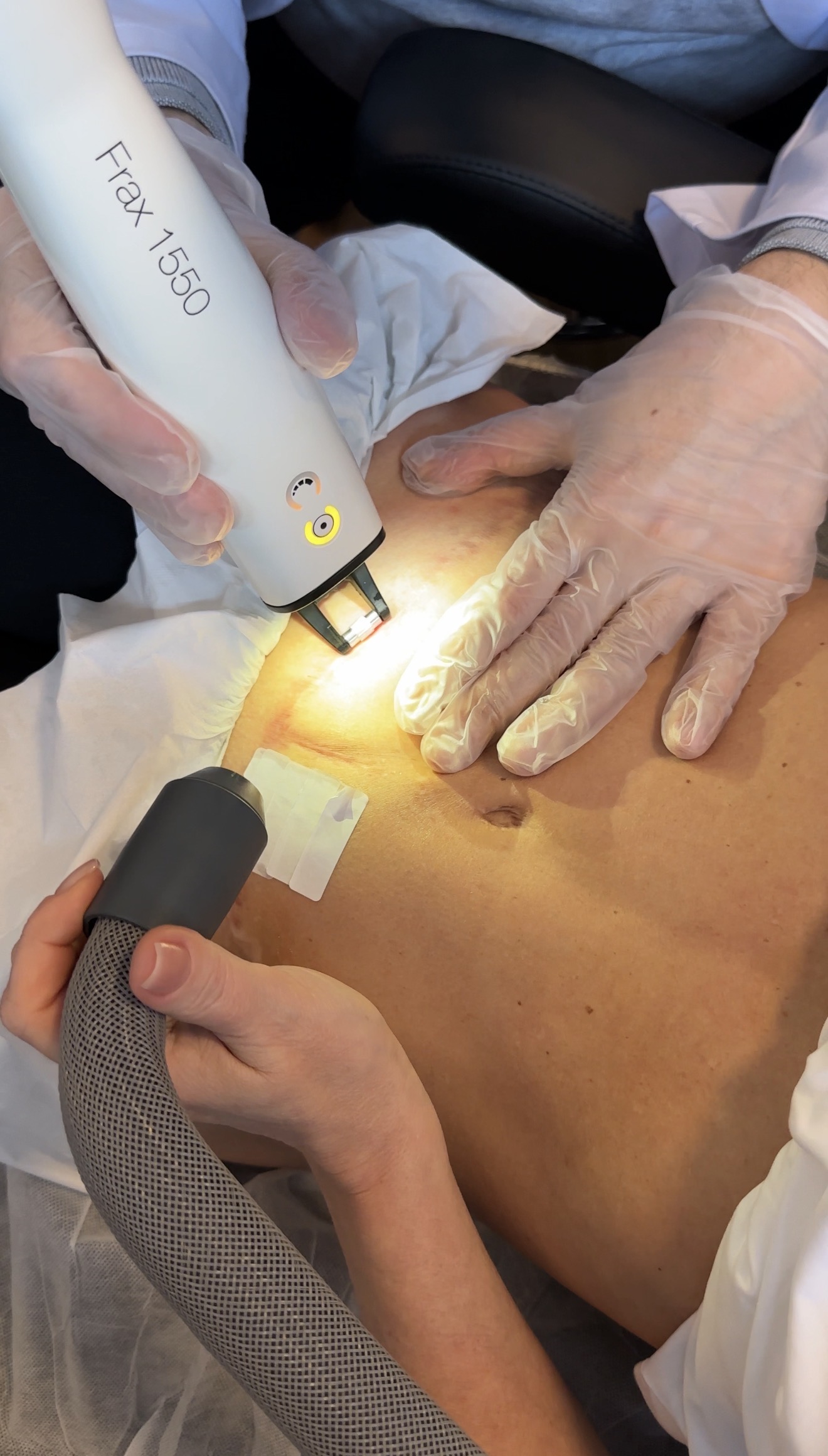 Laser Narbenbehandlung Bonn – Haute Contour