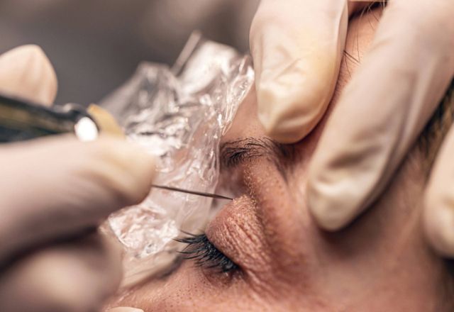 Plasmapen Plasmalift Bonn – Haute Contour