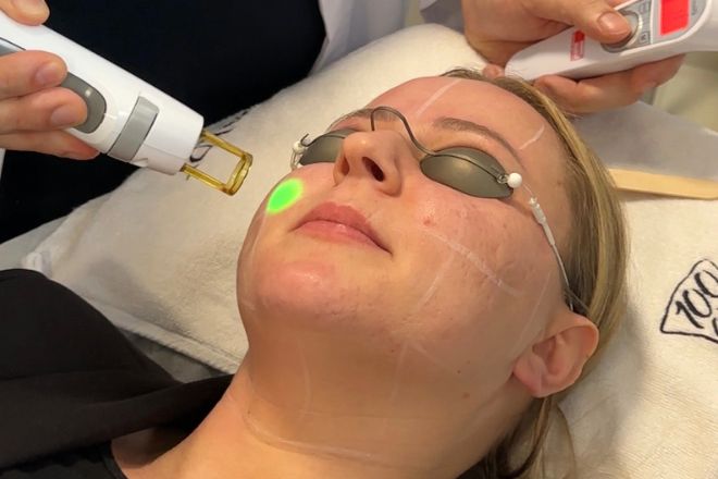 Laser Anti-Aging Behandlung Bonn – Haute Contour